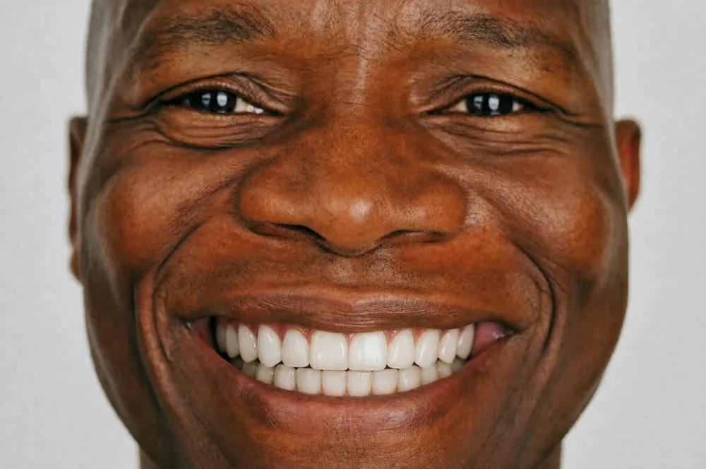 Second example smile after AI simulation